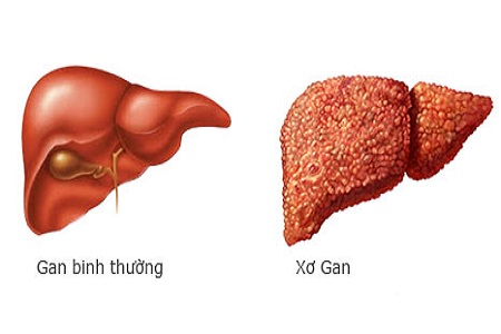 Xơ gan có nguy hiểm không? Xem ngay kẻo lỡ!